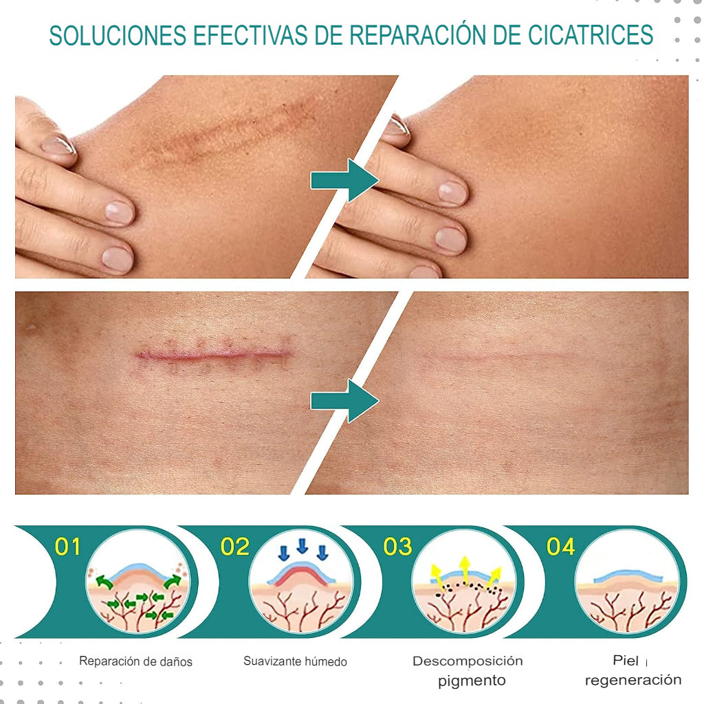 SiliconeScar - Set de 2 Parches de Silicona para la eliminación de cicatrices