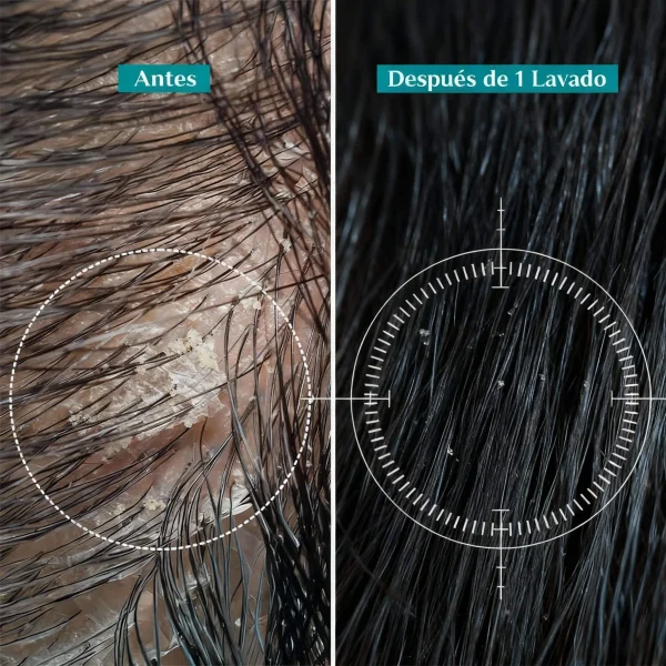 Shampoo Biru™ Anticaspa con Menta y Té Verde – Purifica y Refresca el Cuero Cabelludo - IdeasLabCo™, imagen 2